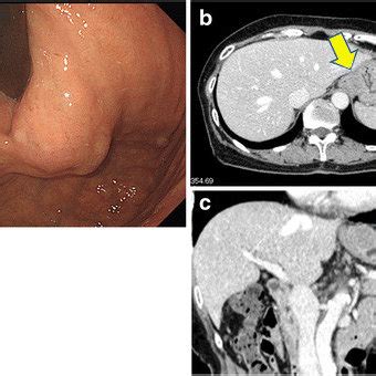 PDF A Gastrointestinal Stromal Tumor At The Esophagogastric Junction