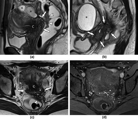 Mri Technique For The Preoperative Evaluation Of Deep Infiltrating Endometriosis Current Status