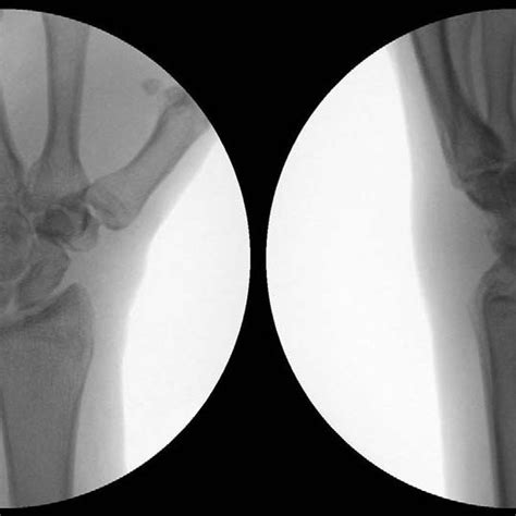 Posteroanterior And Lateral Radiographs At Final Follow Up Download