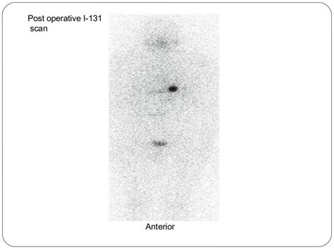 Radionuclide Imaging Thyroid And Parathyroid