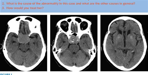 Suprasellar Meningioma Causing Papilledema And Hallucinations