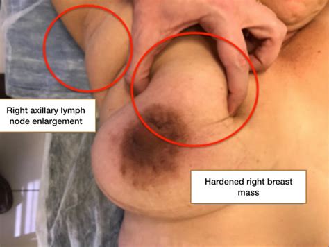 Breast Mass With Enlarged Lymph Nodes Shop Laseb Fae Ufmg Br