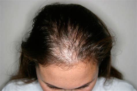 Alopecia Difusa Femenina Causas Y Tratamientos