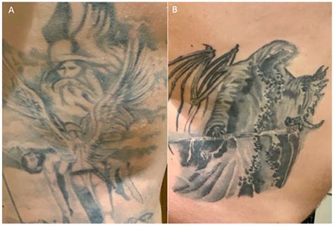 Tattoo Granuloma