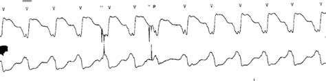 Cardiac Sympathetic Denervation For Refractory Ventricular Arrhythmia