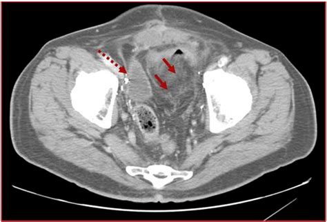 Diversion Ahead Imaging Appearance Of Urinary Diversions And