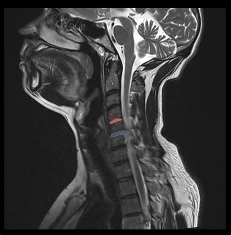 Hernie Discale Cervicale Traitements Et Neurochirurgie Piti