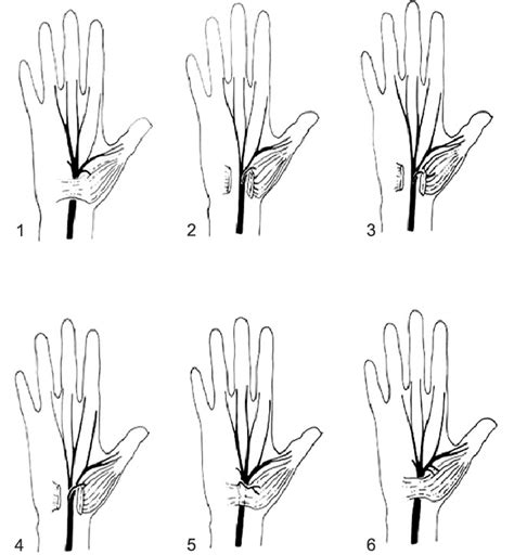 Anatomic Variations Of Median Nerve 1 Usual Branching Of The Median Download Scientific