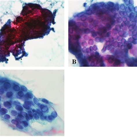 Cytological Findings By Fine Needle Aspiration Of The Thyroid Tumor