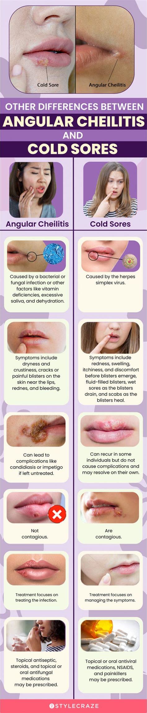 Angular Stomatitis Vs Cold Sore