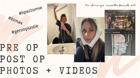 Ma chirurgie maxilo faciale Vlog 12 Pré post op bimax genio