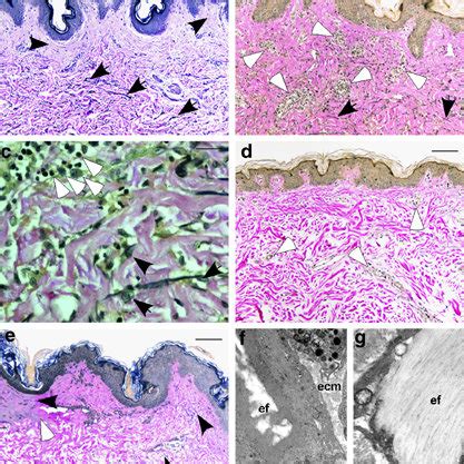 Skin Disease Progression Histology And Electron Microscopy A