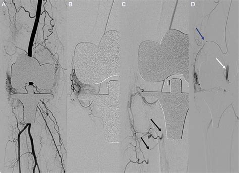 Geniculate Artery Embolization In Patients With Recurrent Hemarthrosis