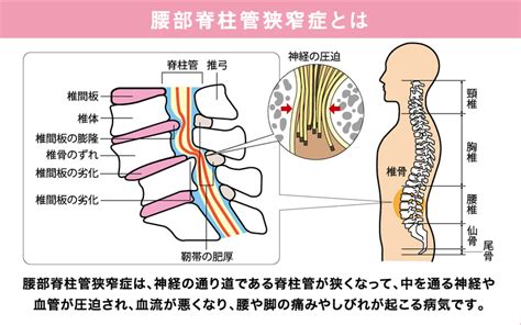 腰部脊柱管狭窄症 尾張旭市で整骨院なら最短1回で痛みを改善するうの整骨院