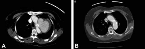 Endovascular Repair Of Mycotic Aneurysm Of The Descending Thoracic