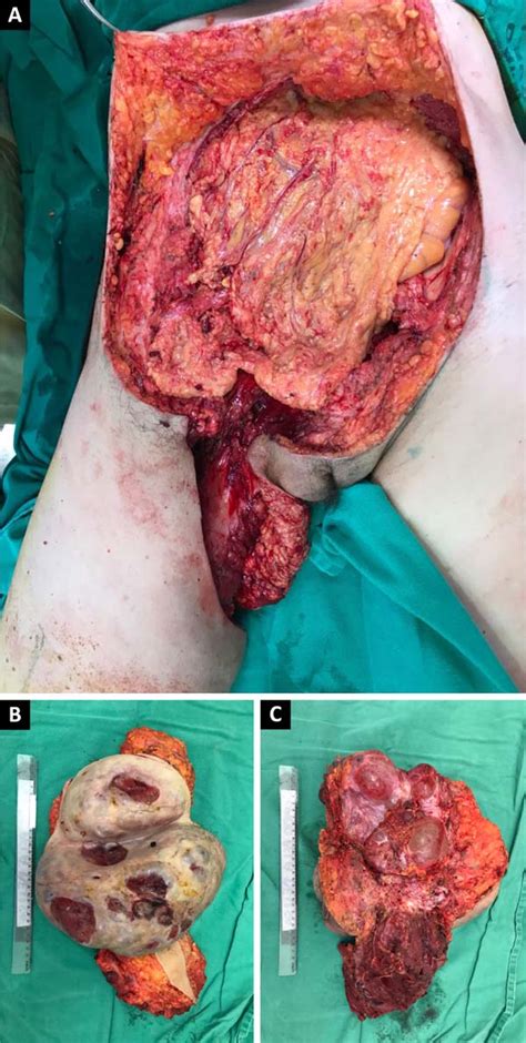 Rbcp Multicystic Epithelioid Mesothelioma Infiltrating Abdominal Wall