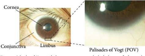 Figure 1 from Limbal stem cell deficiency: special focus on tracking ...