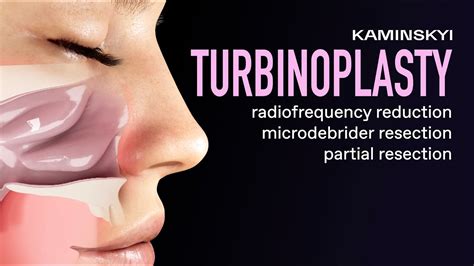 Turbinoplasty Radiofrequency Reduction Microdebrider Resection