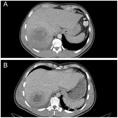 A Case Of Entamoeba Histolytica Infection Among Men Who Have Sex With Men Kristen Farraj