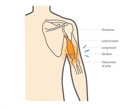 Partial Tricep Tendon Tear Archives Samarpan Physiotherapy Clinic