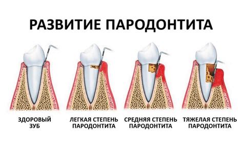 Пародонта - причины, симптомы, лечения в Ереване, Армения