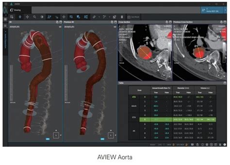 혁신의료기술 ‘aview Neuro Cad 뇌출혈 진단 Ai로 각광