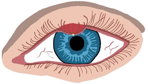 Chalazion Vs Hordeolum