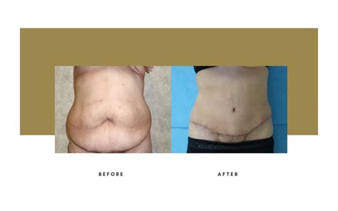 Abdominoplasty Beverly Hills Julie Edween Do