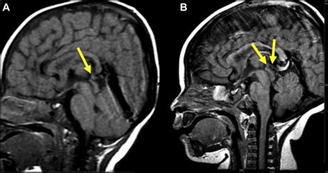 Magnetic Resonance Imaging Screening For Trilateral Retinoblastoma Ophthalmology Retina