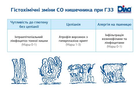 Глютен-залежні захворювання: особливості діагностики