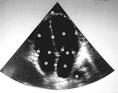 Basic Sonography Apical Chamber Diagram Quizlet