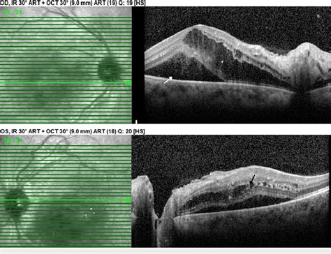 Optical Coherence Tomography Ou Initial Visit Macular Edema With Download Scientific Diagram