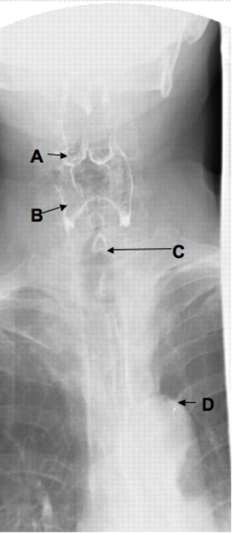 Barium Swallow Anterior Posterior View The Bmj