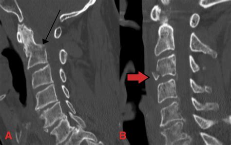 Cervical Fracture Teachmesurgery