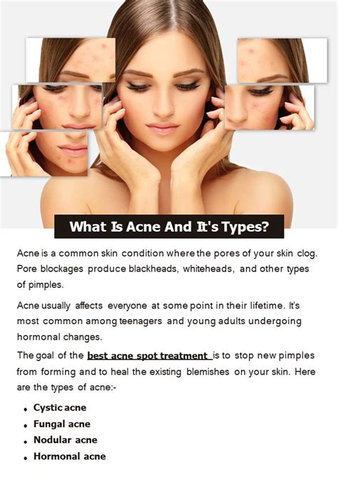 Ppt What Is Acne And Its Types Powerpoint Presentation Free To