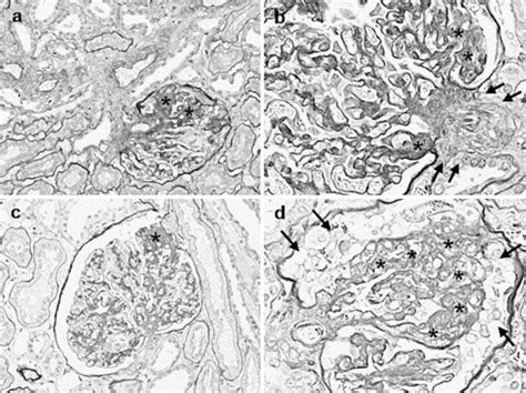 Histological Characteristics Of Focal Segmental Glomerulosclerosis A