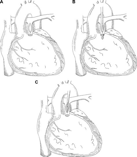 Tetralogy Of Fallot Repair How I Teach It The Annals Of Thoracic Surgery