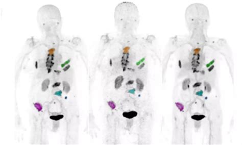 Ga 68 Radiotracer Better Than FDG For Diagnosing Liver Cancer Study