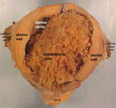 Filehydatidiform Mole Embryology