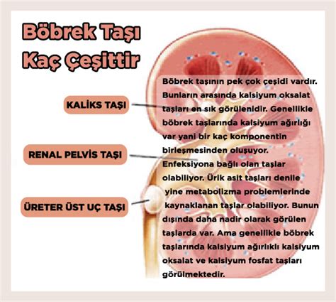 BELİRTİLER Böbrek Taşı Kaç Çeşittir