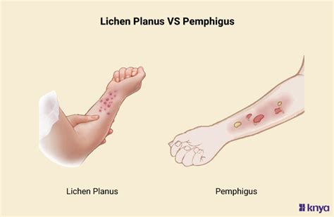 Decoding Dermatological Disorders Lichen Planus Vs Pemphigus Knya