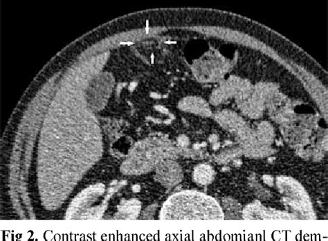 [pdf] Radiologic Findings Of Epiploic Appendagitis Semantic Scholar