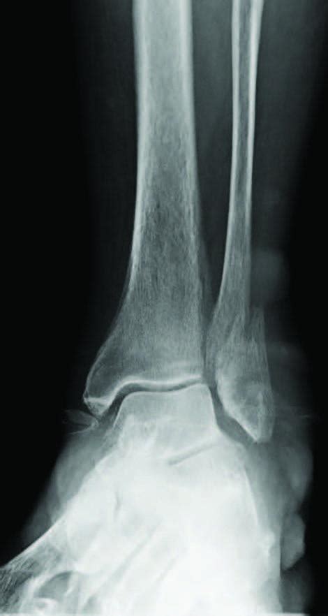 Normal Ray X Ankle Joint