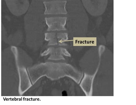 Vertebral Fracture Interventional Radiology Ucla Health