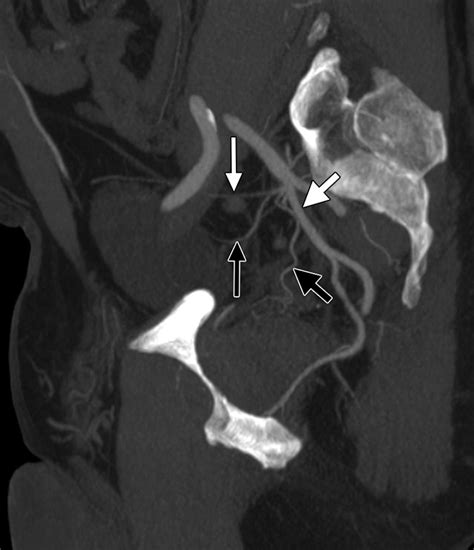 Angiographic Anatomy Of The Male Pelvic Arteries AJR