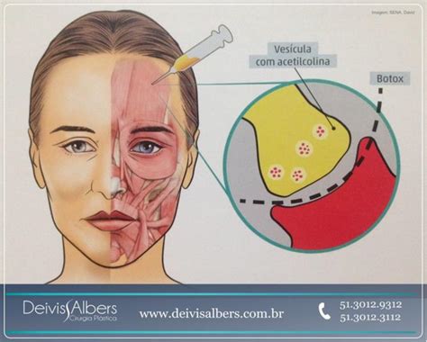 Entenda Como Funciona O Mecanismo De Ação Da Toxina Botulínica Deivis