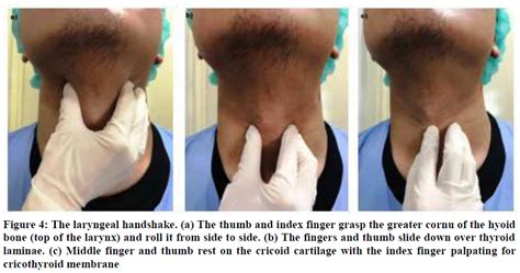 Cricothyroid Membrane Incision