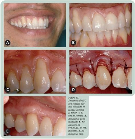 Técnicas de cirugía mucogingival para el cubrimiento radicular