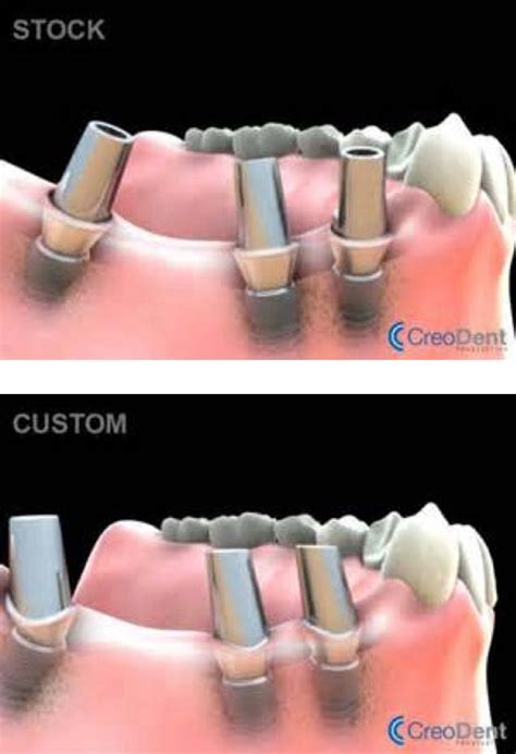 Dental Implants Mid State Oral Surgery And Implant Center