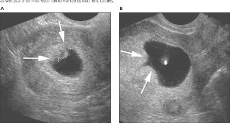 Figure 3 from The chorionic bump: a first-trimester pregnancy ...